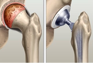ARTROPLASTIA DE QUADRIL E JOELHO