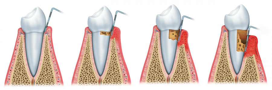 Você sabe o que é doença periodontal?