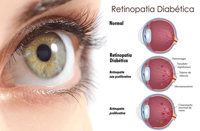 RETINOPATIA DIABÉTICA