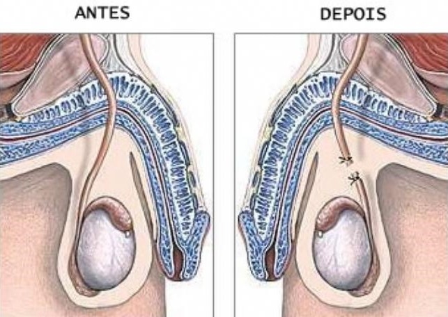 VASECTOMIA: MÉTODO DE CONTRACEPÇÃO MASCULINA.