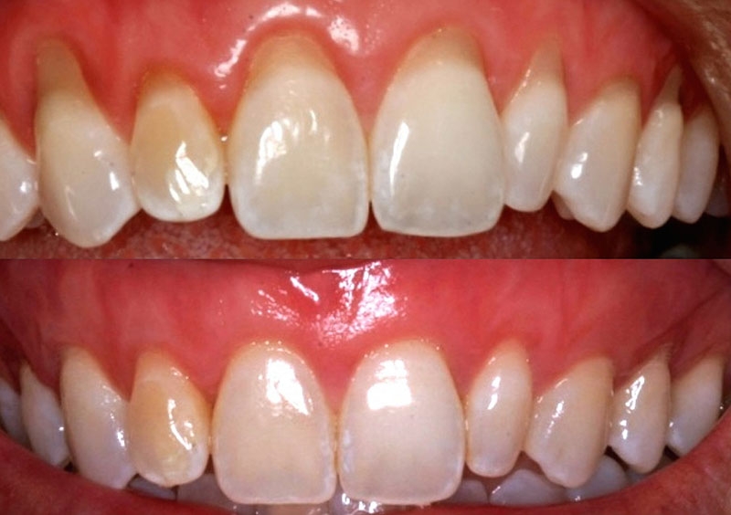 PLÁSTICA GENGIVAL: PROCEDIMENTO RESPONSÁVEL PELO SORRISO MAIS BONITO E SAUDÁVEL