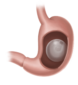 Sobrepeso e obesidade: alternativas de tratamento  A cirurgia bariátrica e o balão intragástrico são ótimas alternativas para o tratamento da obesidade nos dias atuais