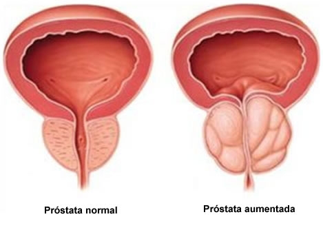 HIPERPLASIA PROSTÁTICA BENIGNA - O ´´INCHAÇO`` BENIGNO DA PRÓSTATA
