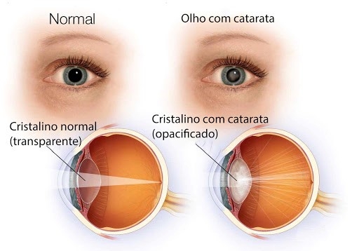 CATARATA: O QUE É, SINTOMAS, DIAGNÓSTICO E TRATAMENTO