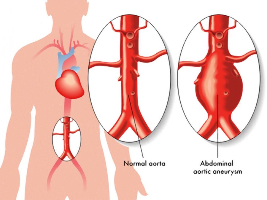 Capa do artigo DOENÇAS ARTERIAIS: CARÓTIDA E ANEURISMA DE AORTA