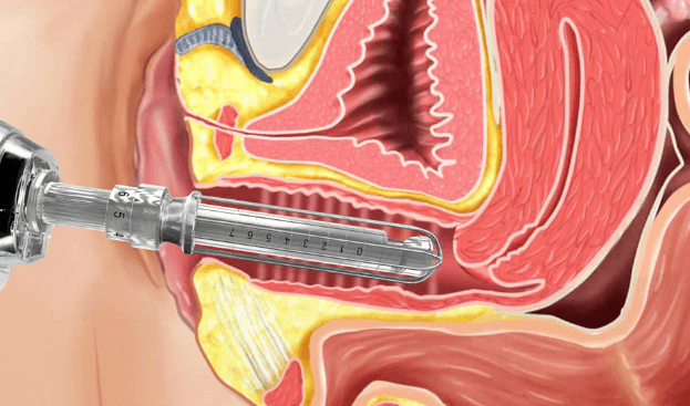 Capa do artigo REJUVENESCIMENTO DA REGIÃO ÍNTIMA: USO DE LASER E RADIOFREQUÊNCIA