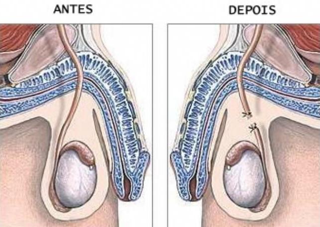 VASECTOMIA: MÉTODO DE CONTRACEPÇÃO MASCULINA.