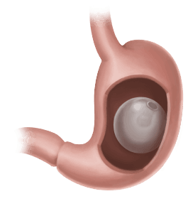 Capa do artigo Sobrepeso e obesidade: alternativas de tratamento  A cirurgia bariátrica e o balão intragástrico são ótimas alternativas para o tratamento da obesidade nos dias atuais