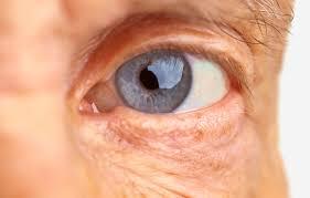 O que é degeneração macular relacionada à idade (DMRI)? 