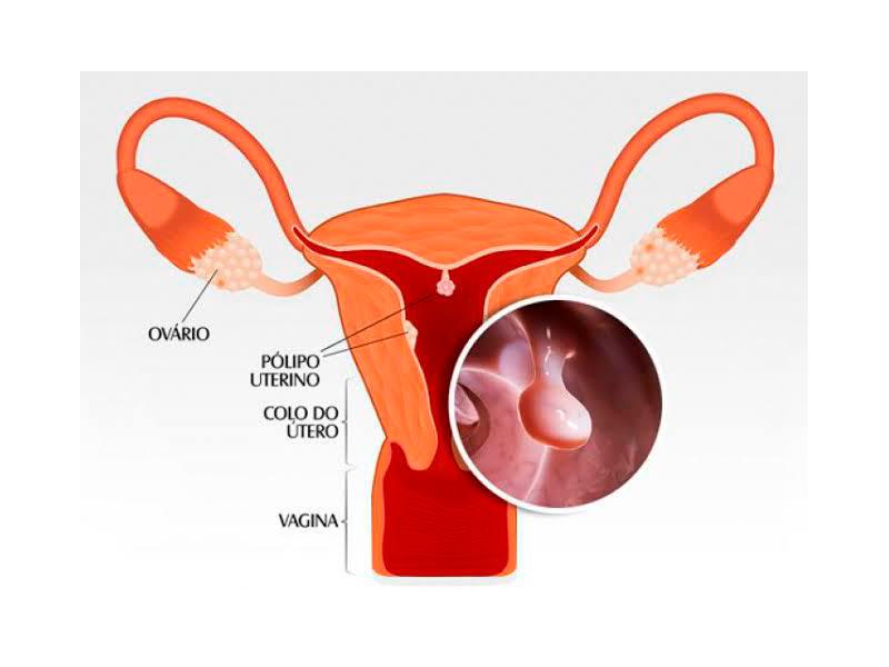 Pólipos endometriais