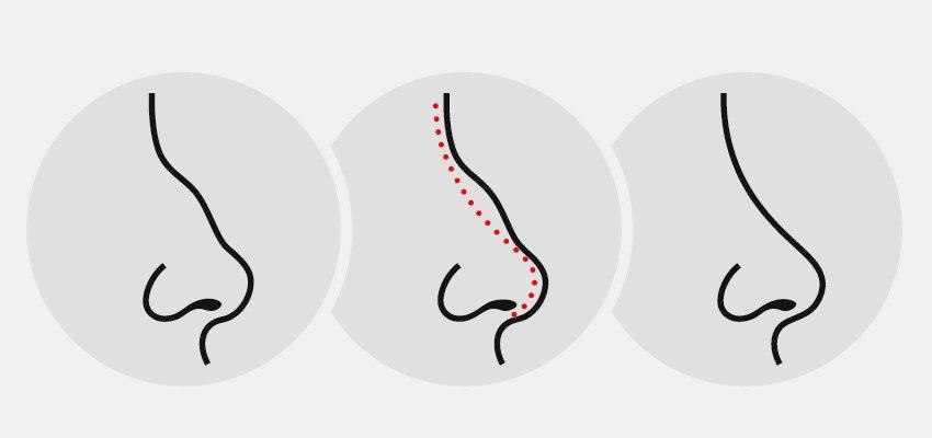RINOPLASTIA COM ENXERTO DE CARTILAGEM DE COSTELA
