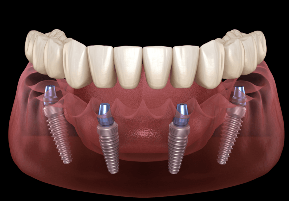 Capa do artigo Implantes dentários & próteses tipo protocolo