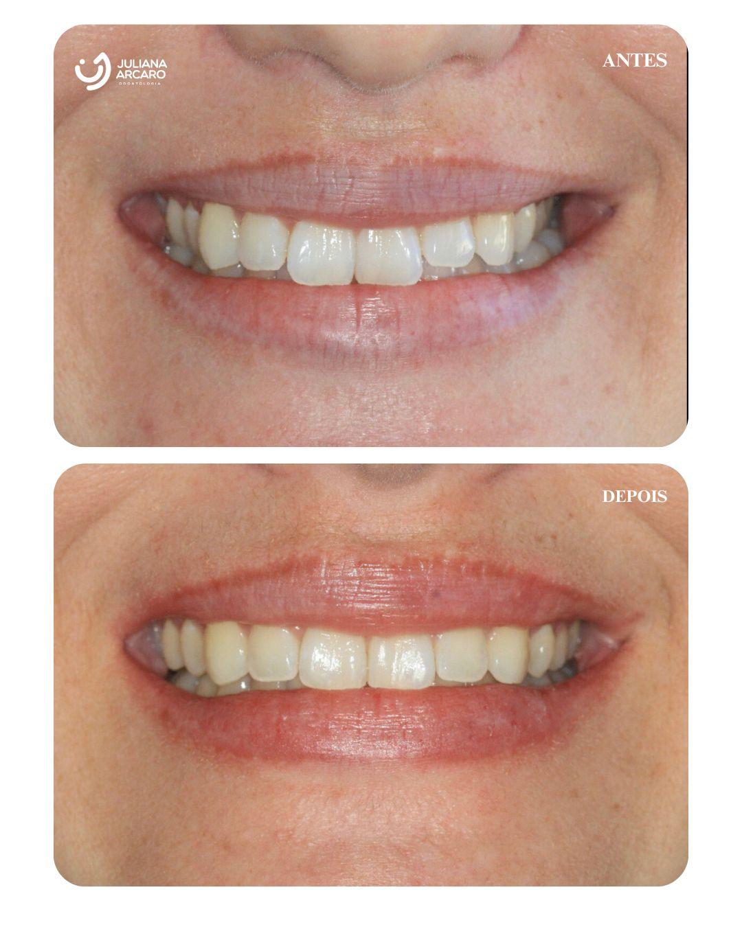 Uma nova solução para a correção do “sorriso estreito``