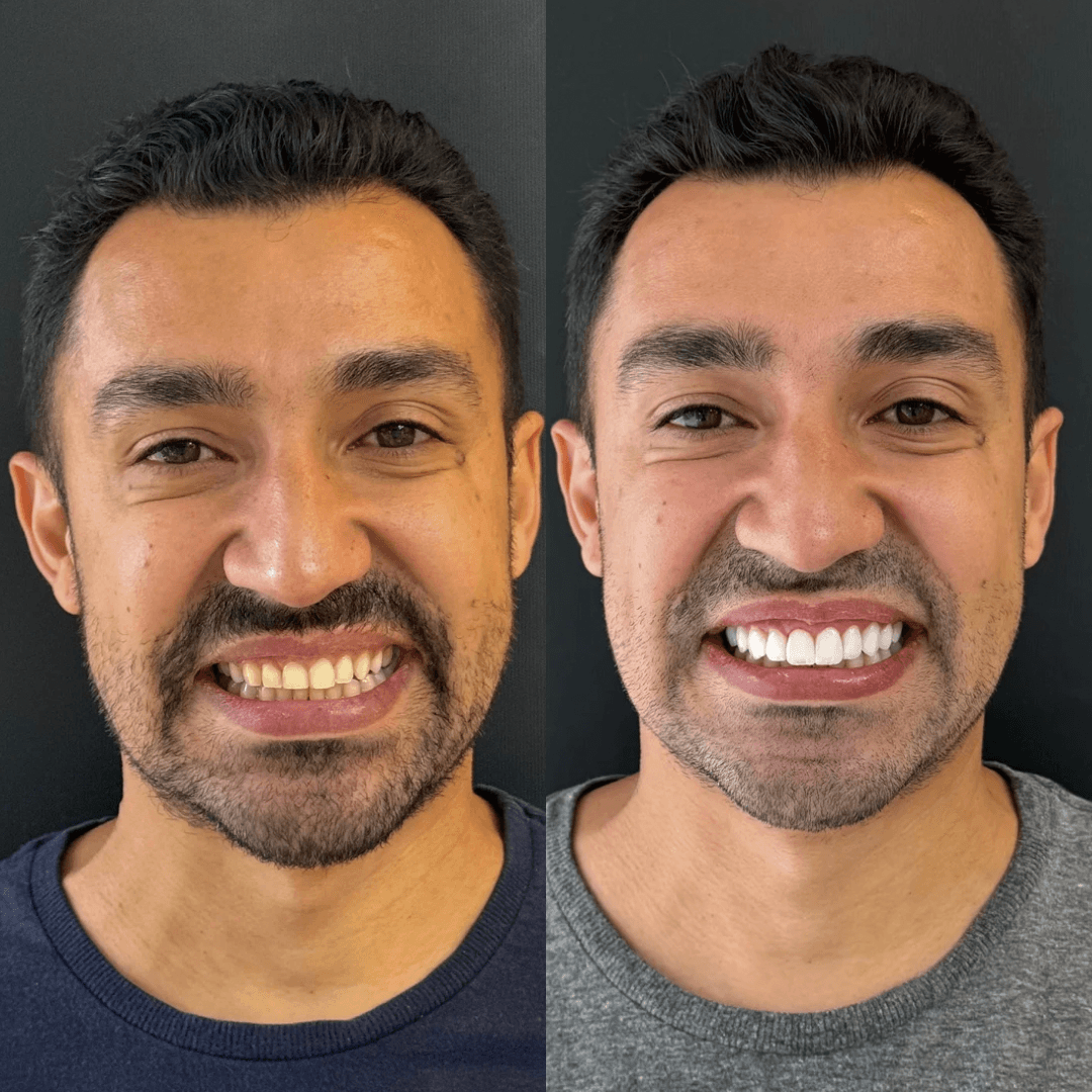 Capa do artigo Facetas em Resina: Restauração e Beleza Natural para o Seu Sorriso