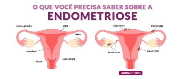 Capa do artigo Endometriose: o que é, causas e diagnóstico