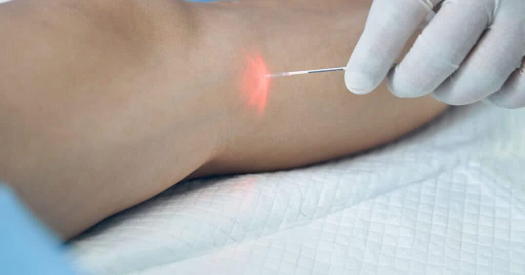 Capa do artigo Laser endovenoso: O que é, como funciona e quais suas vantagens