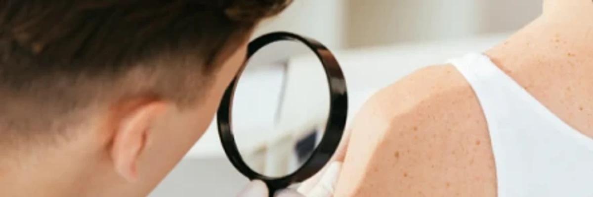 Cirurgia micrográfica de mohs: Um tratamento para o câncer de pele