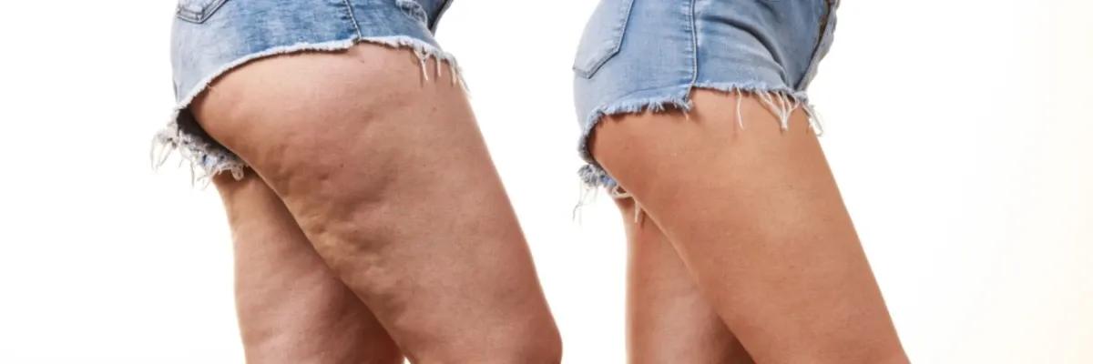 Capa do artigo Lipedema: Como eu trato?
