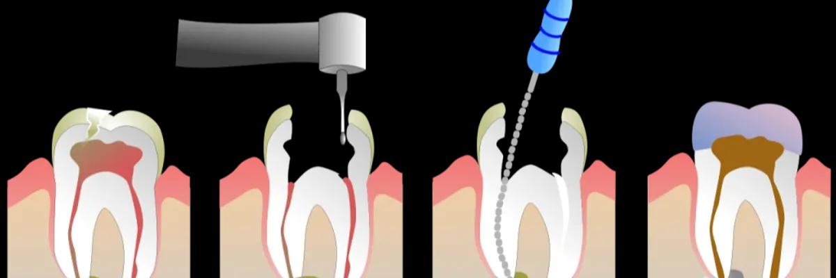 Capa do artigo Tratamento de Canal: tudo o que você precisa saber