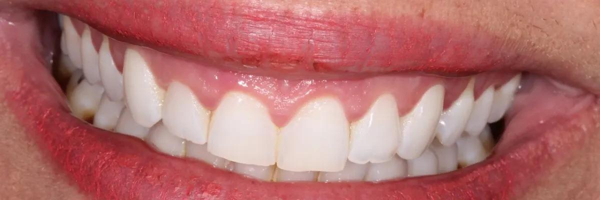 Capa do artigo Cirurgia Plástica Gengival:  A solução para o sorriso gengival