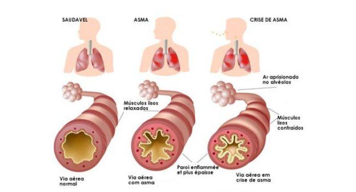Capa do artigo ASMA: CAUSAS, SINTOMAS E DIAGNÓSTICO
