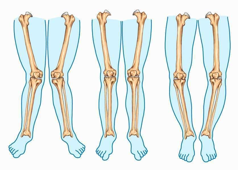 Capa do artigo deformidades dos joelhos na infância