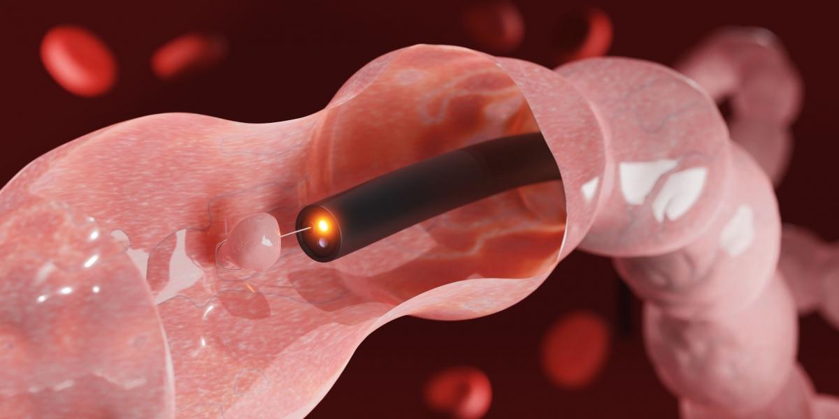 A prevenção do Câncer de Intestino: O papel fundamental da Colonoscopia