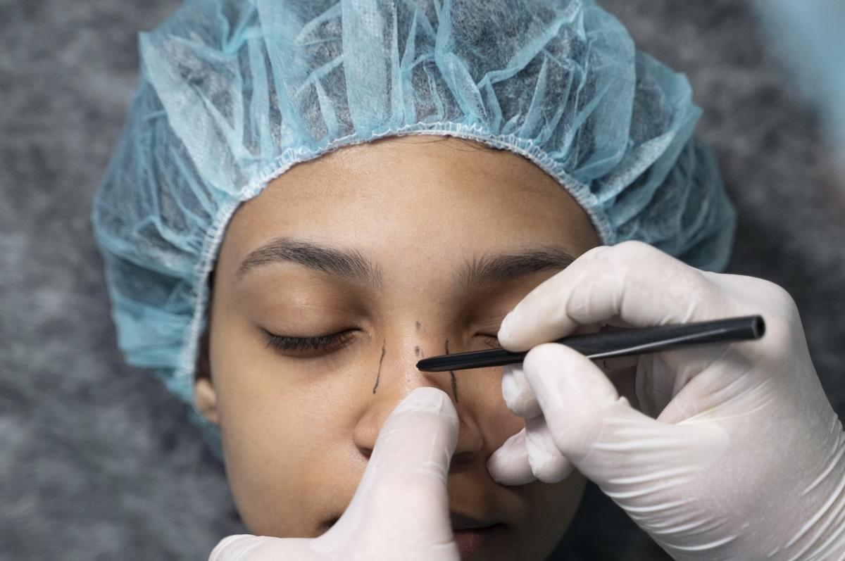 Capa do artigo Rinoplastia revisional com cartilagem de costela: Um novo Horizonte na reconstrução nasal